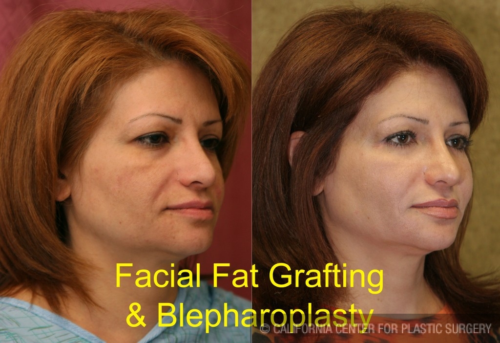 Facial Fat Grafting Before & After Patient #6757