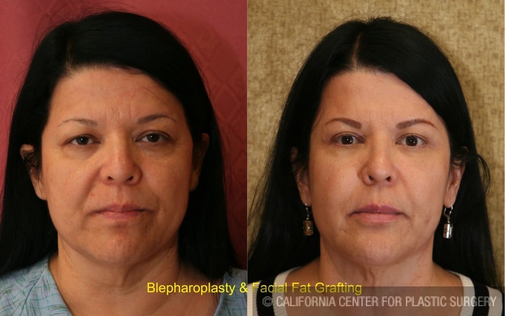 Facial Fat Grafting Before & After Patient #6767
