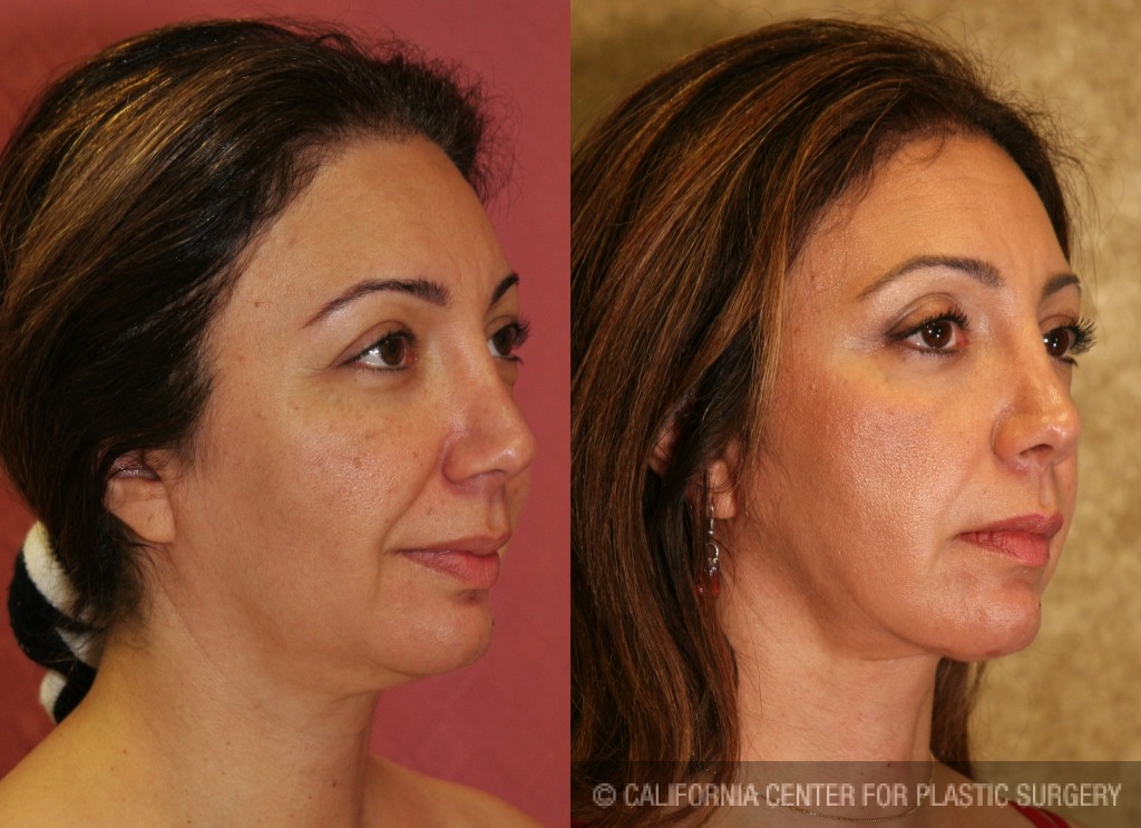 Eyelid (Blepharoplasty) Before & After Patient #6575