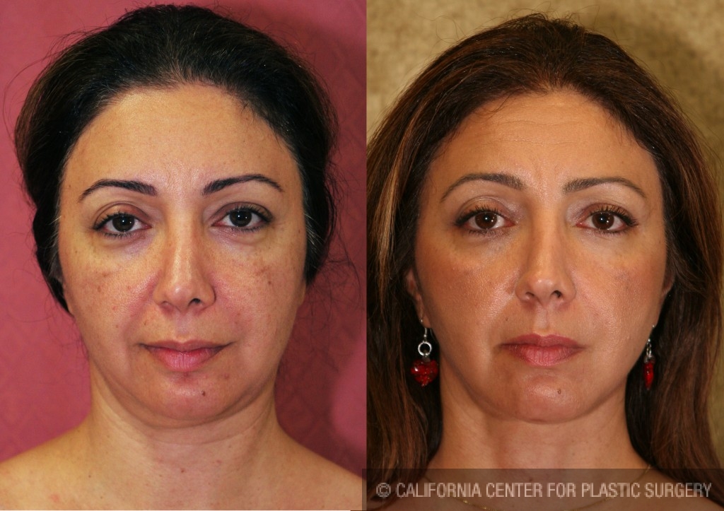 Eyelid (Blepharoplasty) Before & After Patient #6575