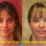 Facial Fat Grafting Before & After Patient #6600