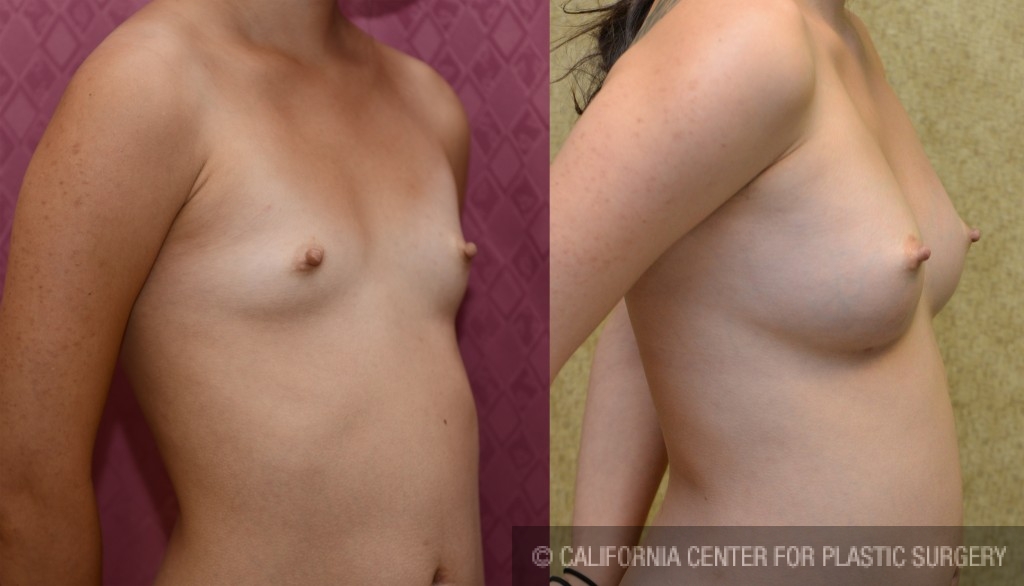 Breast Augmentation (Fat Transfer / Stem Cell) Before & After Patient #5281