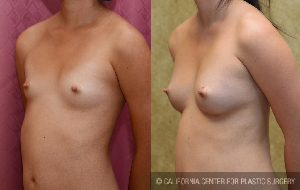 Breast Augmentation (Fat Transfer / Stem Cell) Before & After Patient #5281