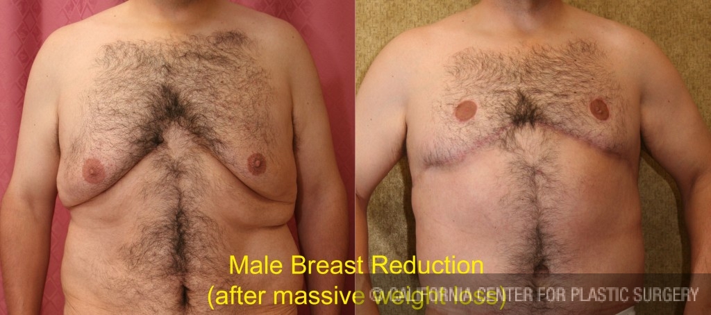 Male gynecomastia (breast) reduction Before & After Patient #6839