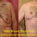 Male gynecomastia (breast) reduction Before & After Patient #6839