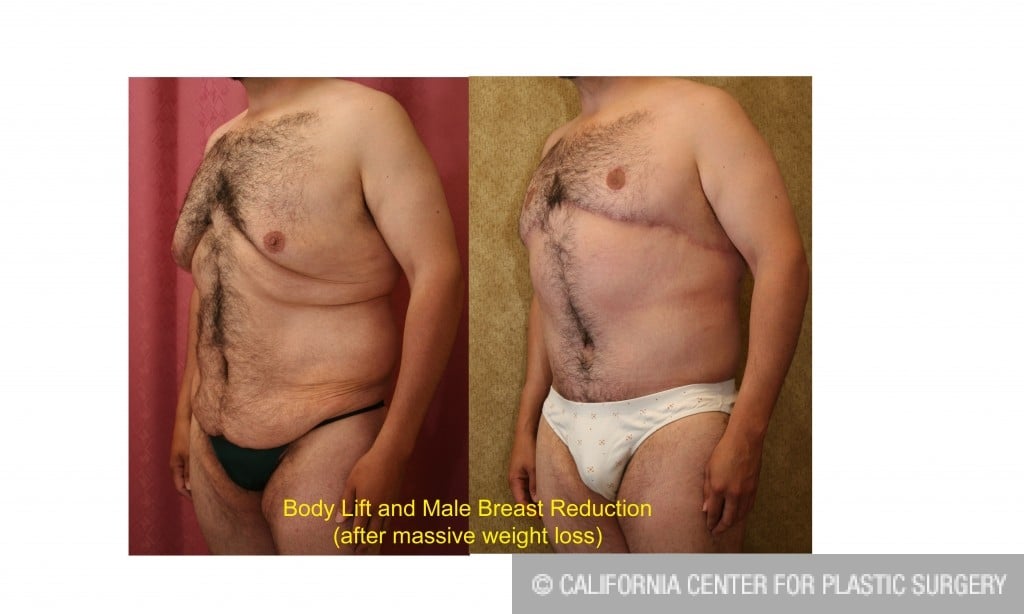 Male gynecomastia (breast) reduction Before & After Patient #6839