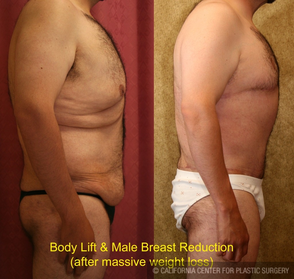 Male Tummy Tuck (abdominoplasty) Before & After Patient #6023