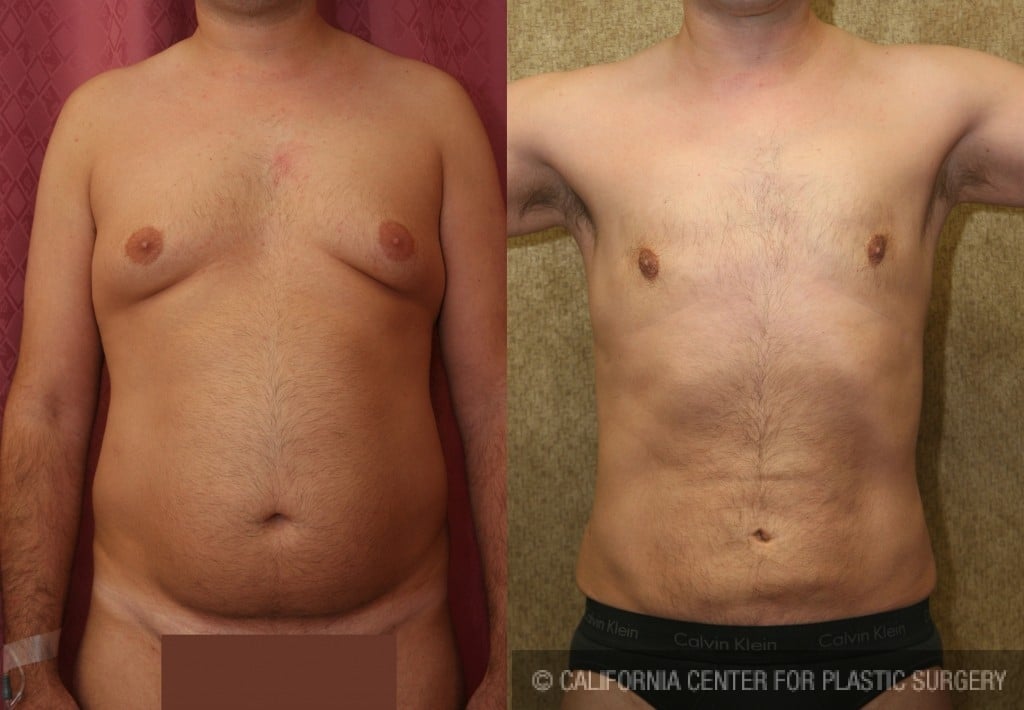 Male Liposuction Abdomen Before & After Patient #5642