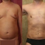Male Liposuction Abdomen Before & After Patient #5642