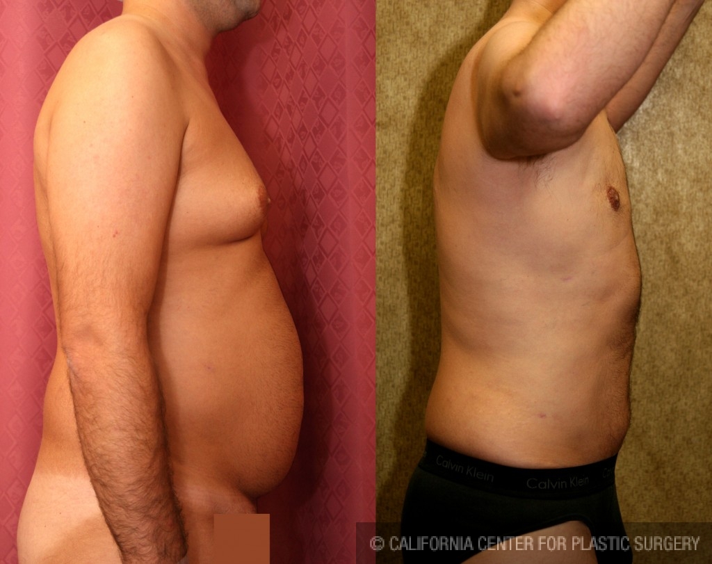 Male Liposuction Abdomen Before & After Patient #5642