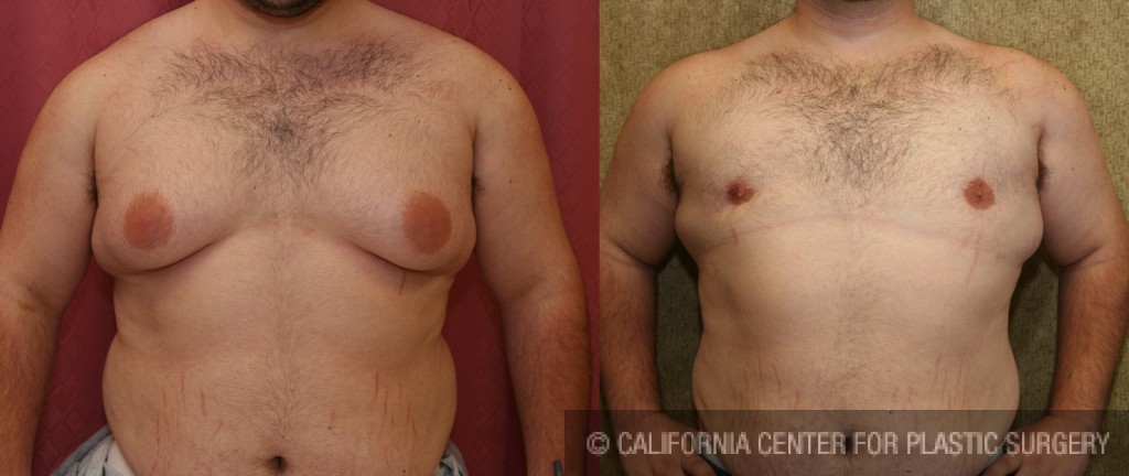 Male gynecomastia (breast) reduction Before & After Patient #6814