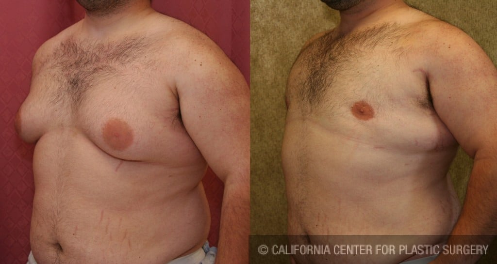 Male gynecomastia (breast) reduction Before & After Patient #6814