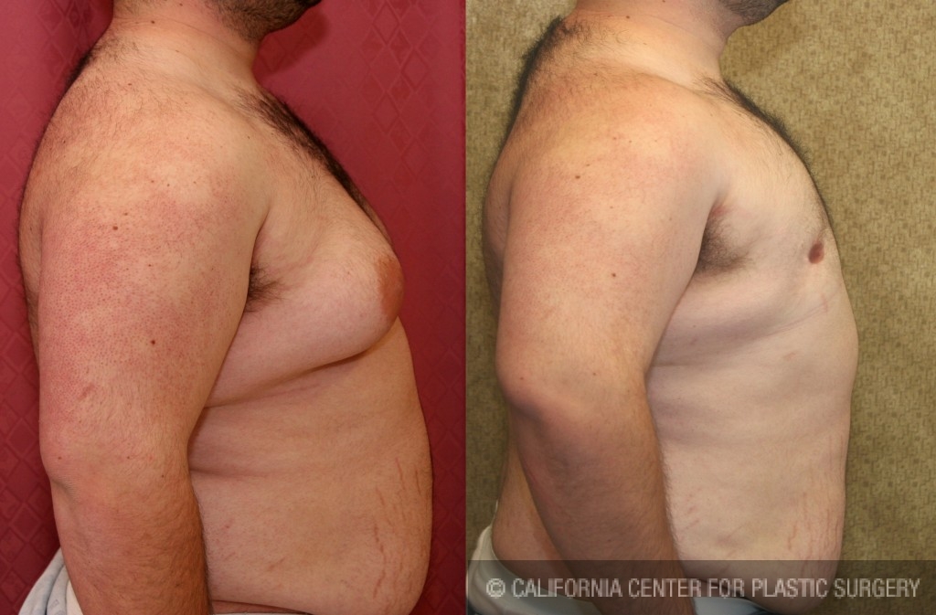 Male gynecomastia (breast) reduction Before & After Patient #6814