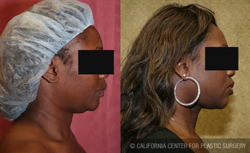 Neck & Face Liposuction Before & After Patient #6667