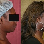 Neck & Face Liposuction Before & After Patient #6667