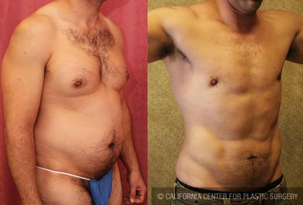 Male Liposuction Abdomen Before & After Patient #5680