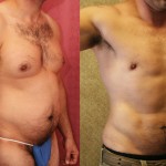 Male Liposuction Abdomen Before & After Patient #5680