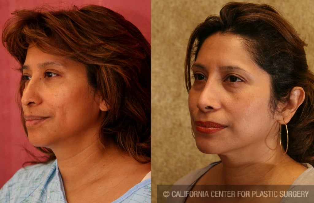 Rhinoplasty - Hispanic Before & After Patient #6284