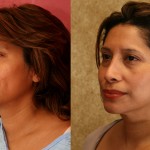 Rhinoplasty - Hispanic Before & After Patient #6284