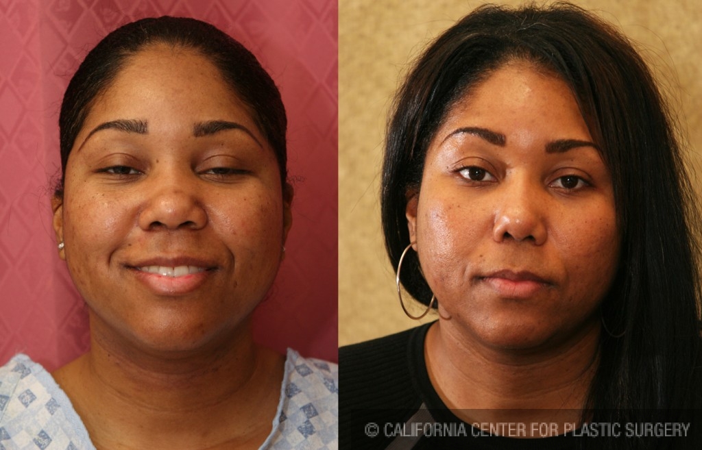 Rhinoplasty - African American Before & After Patient #6300