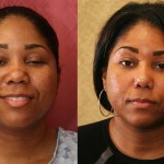 Rhinoplasty - African American Before & After Patient #6300