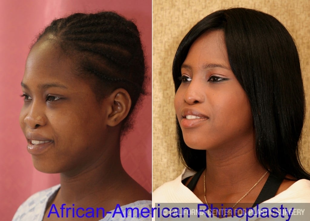 Rhinoplasty - African American Before & After Patient #6319