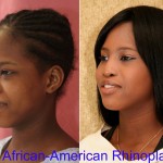 Rhinoplasty - African American Before & After Patient #6319