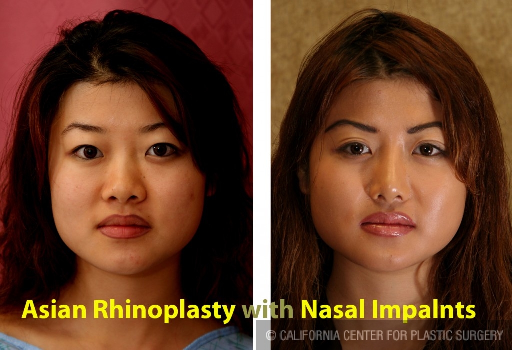 Rhinoplasty - Asian Before & After Patient #6394