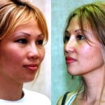 Rhinoplasty - Asian Before & After Patient #6379