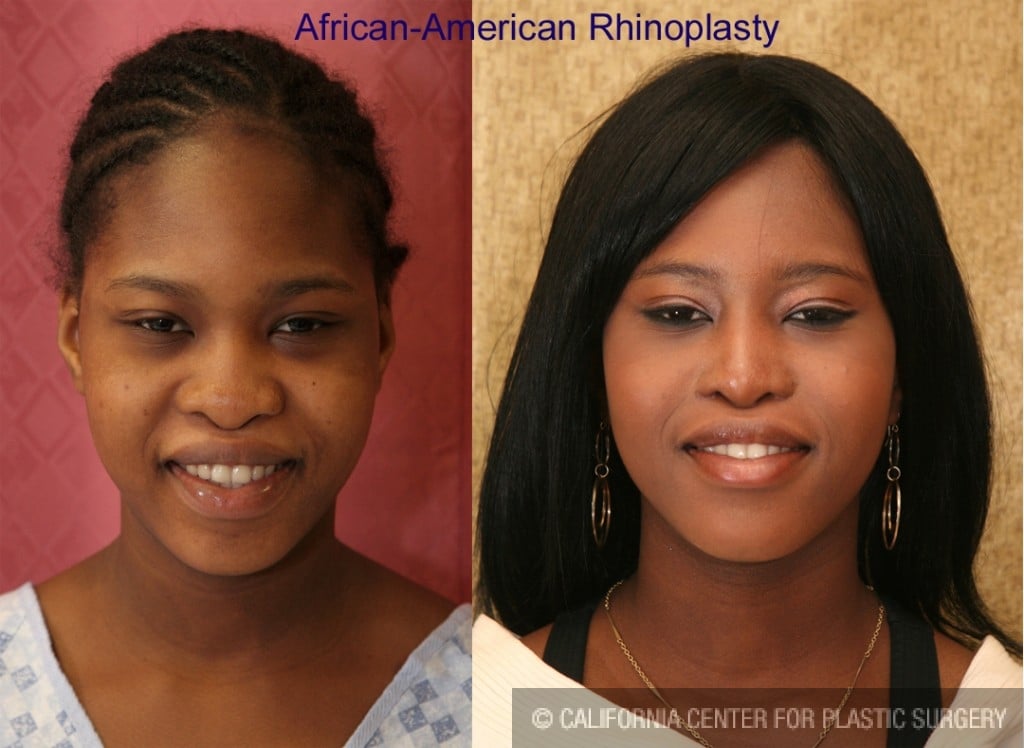 Rhinoplasty - African American Before & After Patient #6319