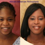 Rhinoplasty - African American Before & After Patient #6319