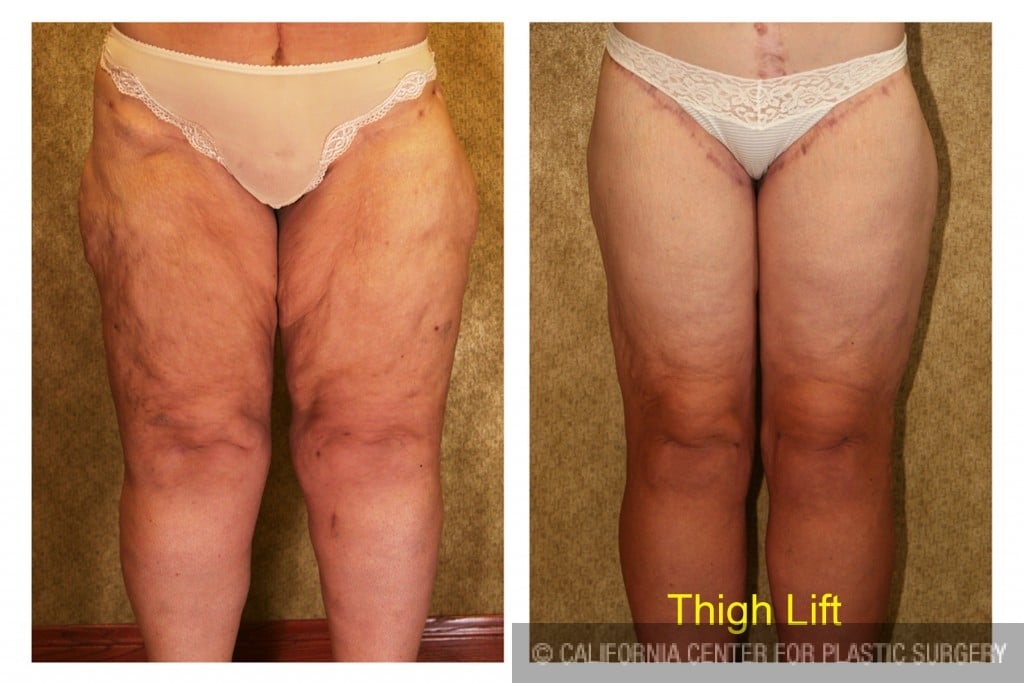 Thigh Lift Before & After Patient #4198