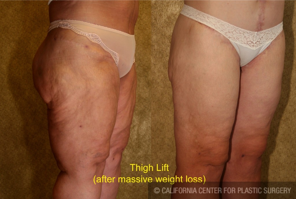 Thigh Lift Before & After Patient #4198