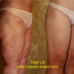 Thigh Lift Before & After Patient #4198