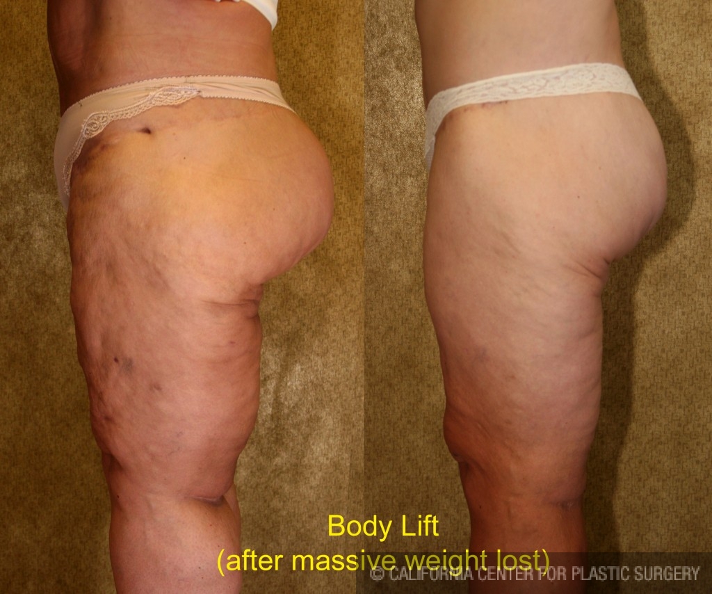 Thigh Lift Before & After Patient #4198
