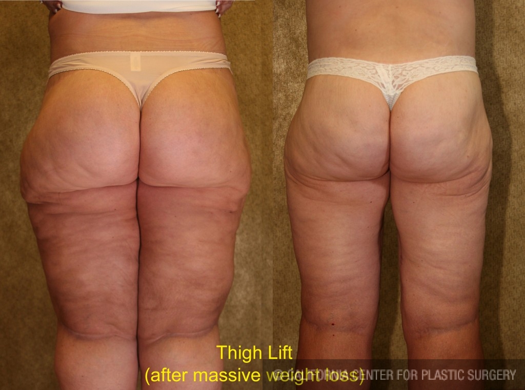 Thigh Lift Before & After Patient #4198