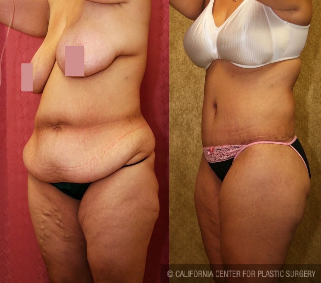 Body Lift Before & After Patient #6036