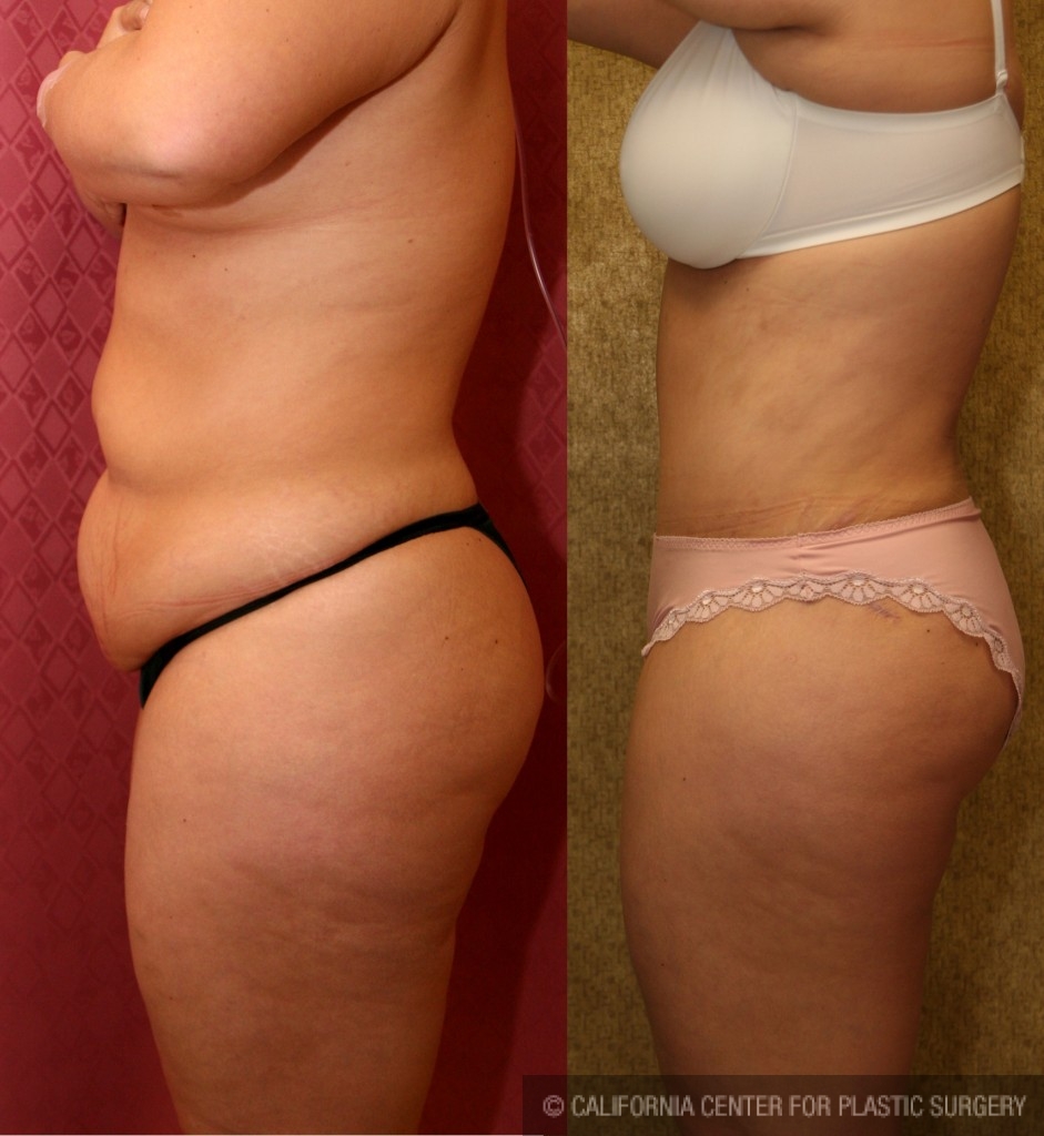 Tummy Tuck (Abdominoplasty) Medium Size Before & After Patient #5755