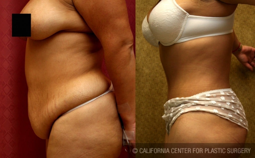 Tummy Tuck (Abdominoplasty) Medium Size Before & After Patient #5817