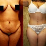 Tummy Tuck (Abdominoplasty) Medium Size Before & After Patient #5817