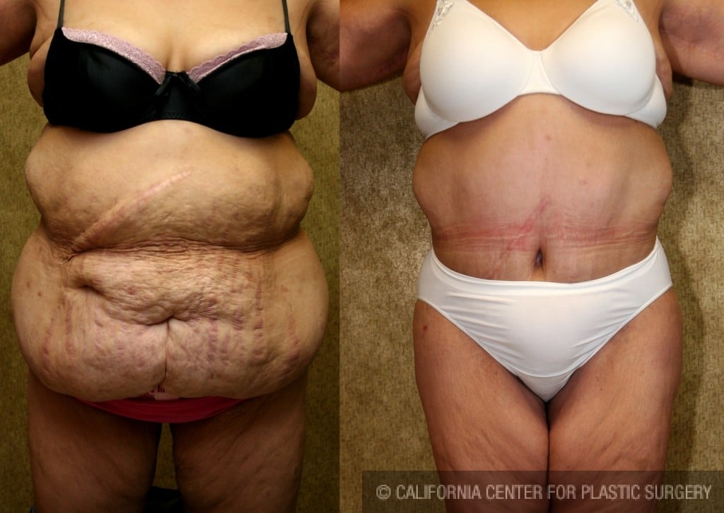 Tummy Tuck (Abdominoplasty) Plus Size Before & After Patient #5898