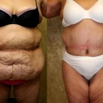 Tummy Tuck (Abdominoplasty) Plus Size Before & After Patient #5898