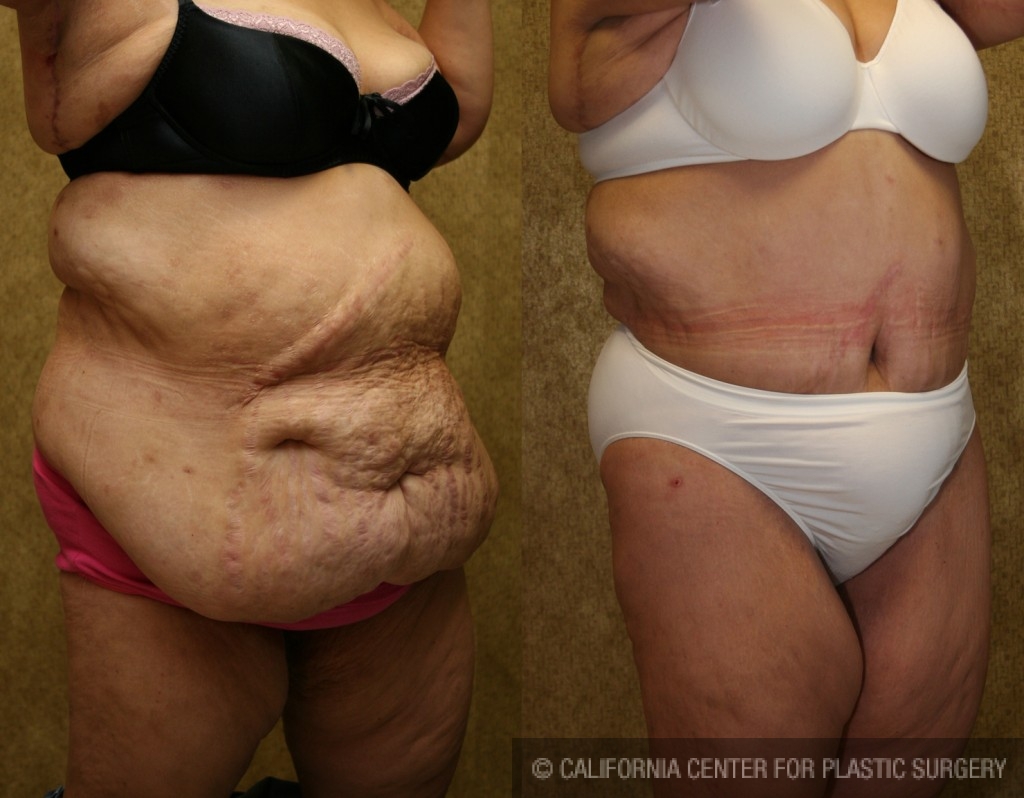Tummy Tuck (Abdominoplasty) Plus Size Before & After Patient #5898