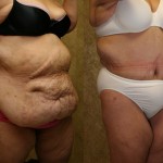 Tummy Tuck (Abdominoplasty) Plus Size Before & After Patient #5898