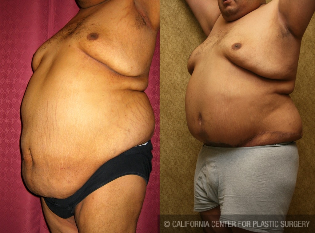 Patient #5903 Tummy Tuck (Abdominoplasty) Plus Size Before and