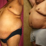 Male Tummy Tuck (abdominoplasty) Before & After Patient #6027