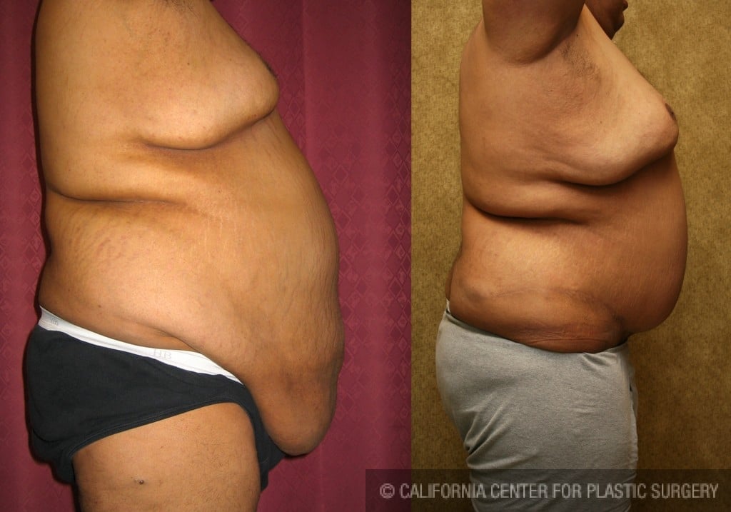 Plus Size Tummy Tuck: High BMI Tummy Tuck