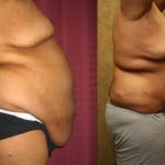Tummy Tuck (Abdominoplasty) Plus Size Before & After Patient #5903