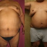 Tummy Tuck (Abdominoplasty) Plus Size Before & After Patient #5903