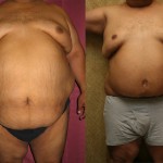 Male Tummy Tuck (abdominoplasty) Before & After Patient #6027